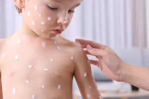 Woman applying cream onto skin of child ill with chickenpox, on blurred background