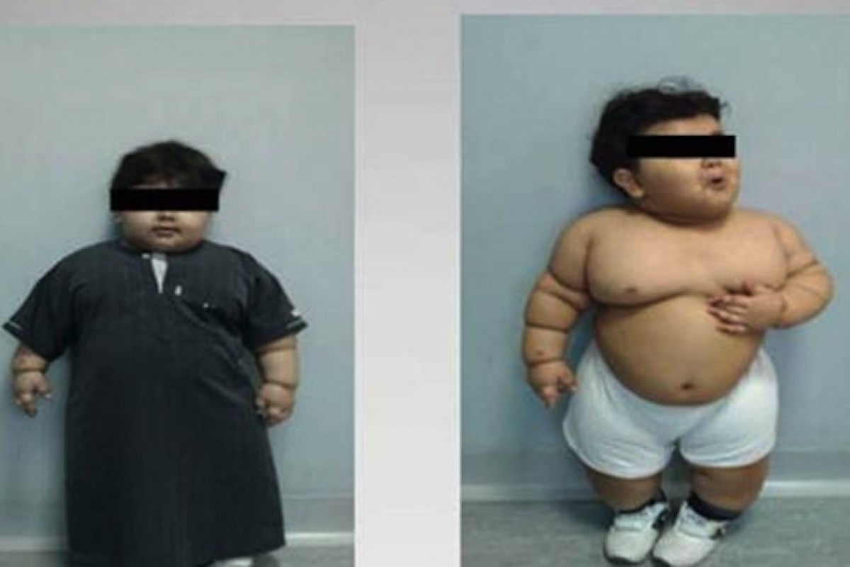 Παχύσαρκο νήπιο υποβάλλεται σε χειρουργική επέμβαση γαστρικής παράκαμψης