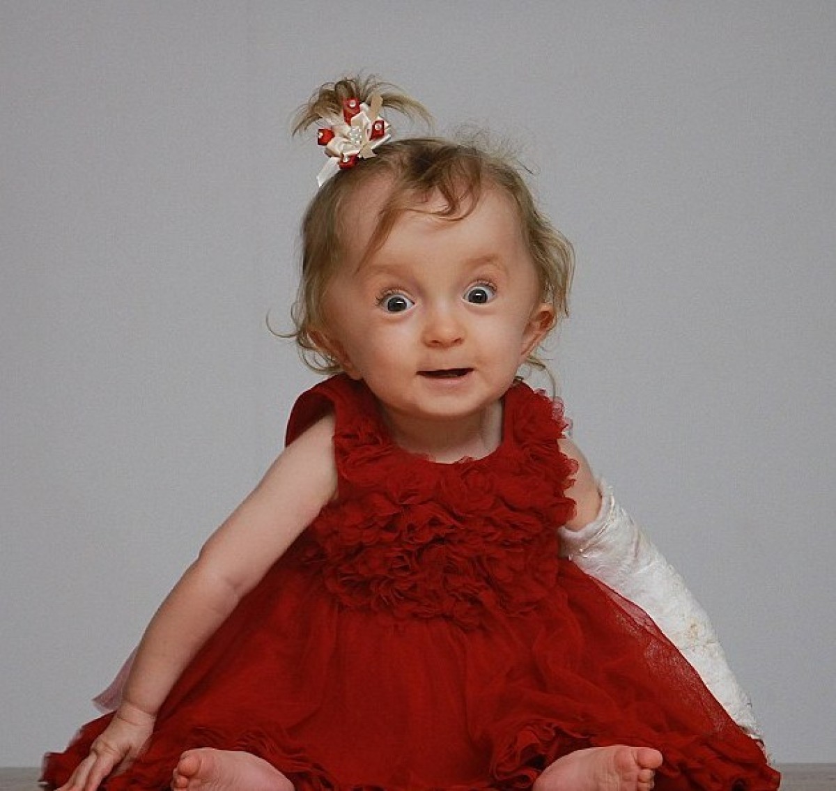 Millie Simpson: Το κοριτσάκι που γεννήθηκε με 30 σπασμένα οστά