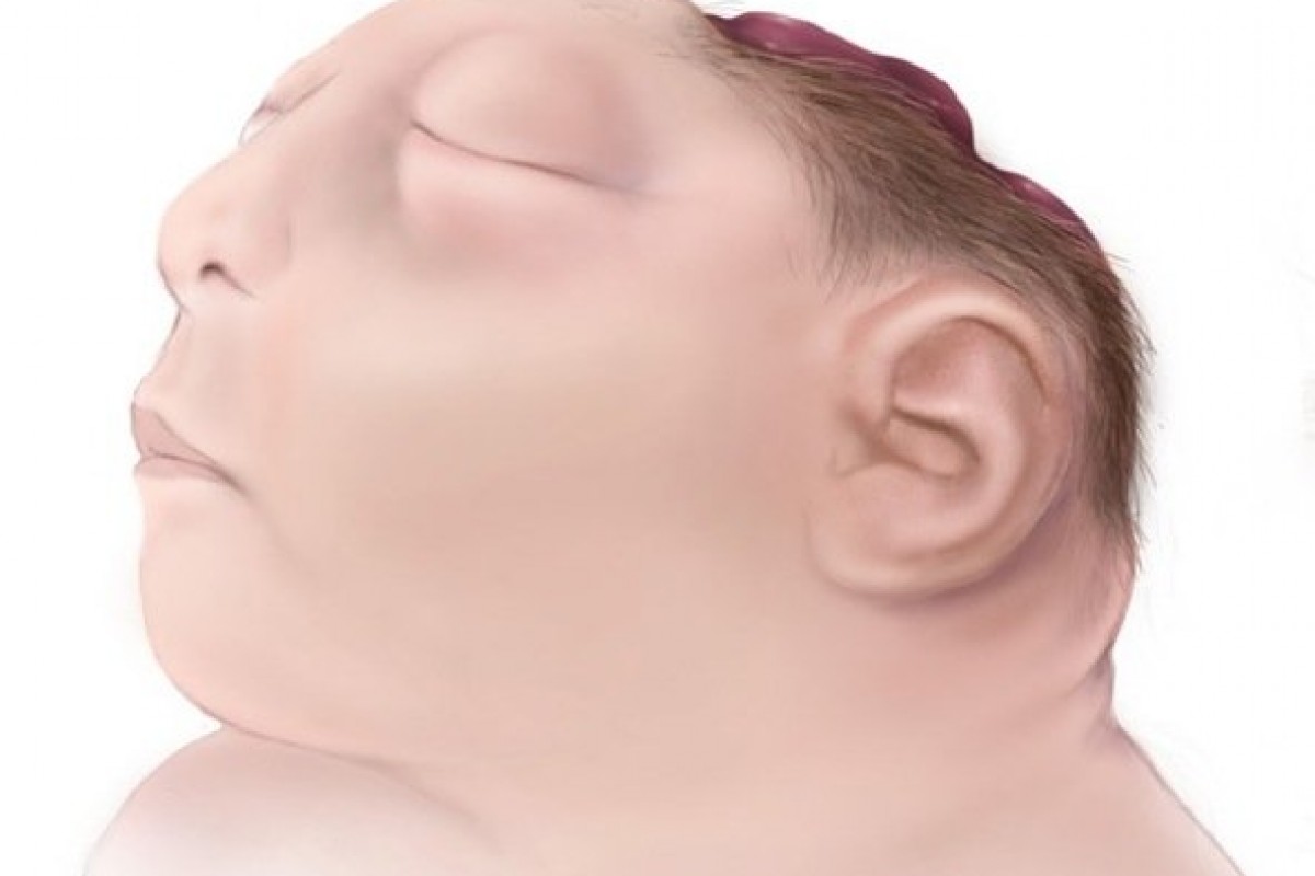 Σπάνιες γενετικές ανωμαλίες εμφάνισαν μωρά στη Ουάσινγκτον – προβληματισμένοι οι επιστήμονες