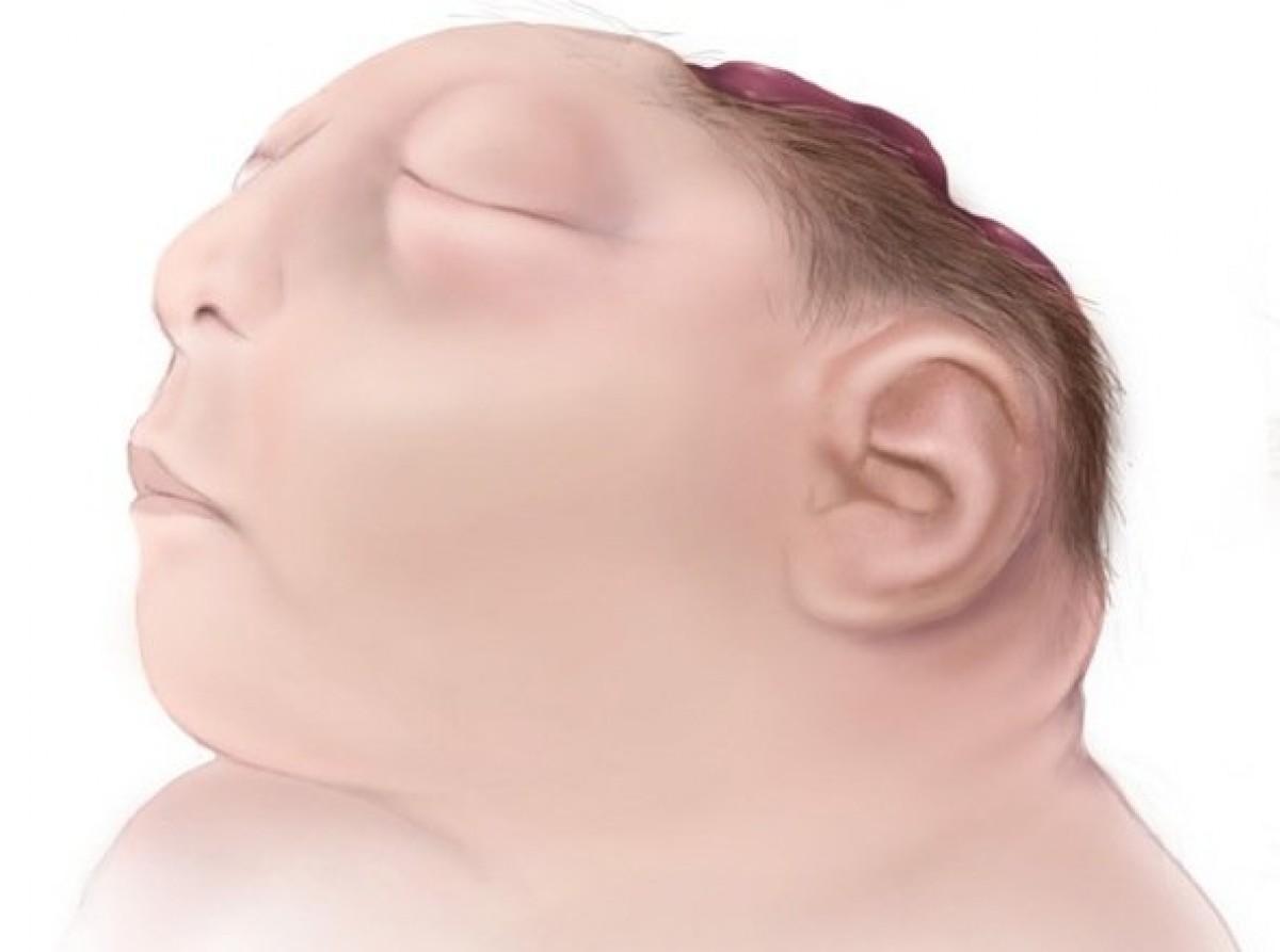 Σπάνιες γενετικές ανωμαλίες εμφάνισαν μωρά στη Ουάσινγκτον – προβληματισμένοι οι επιστήμονες