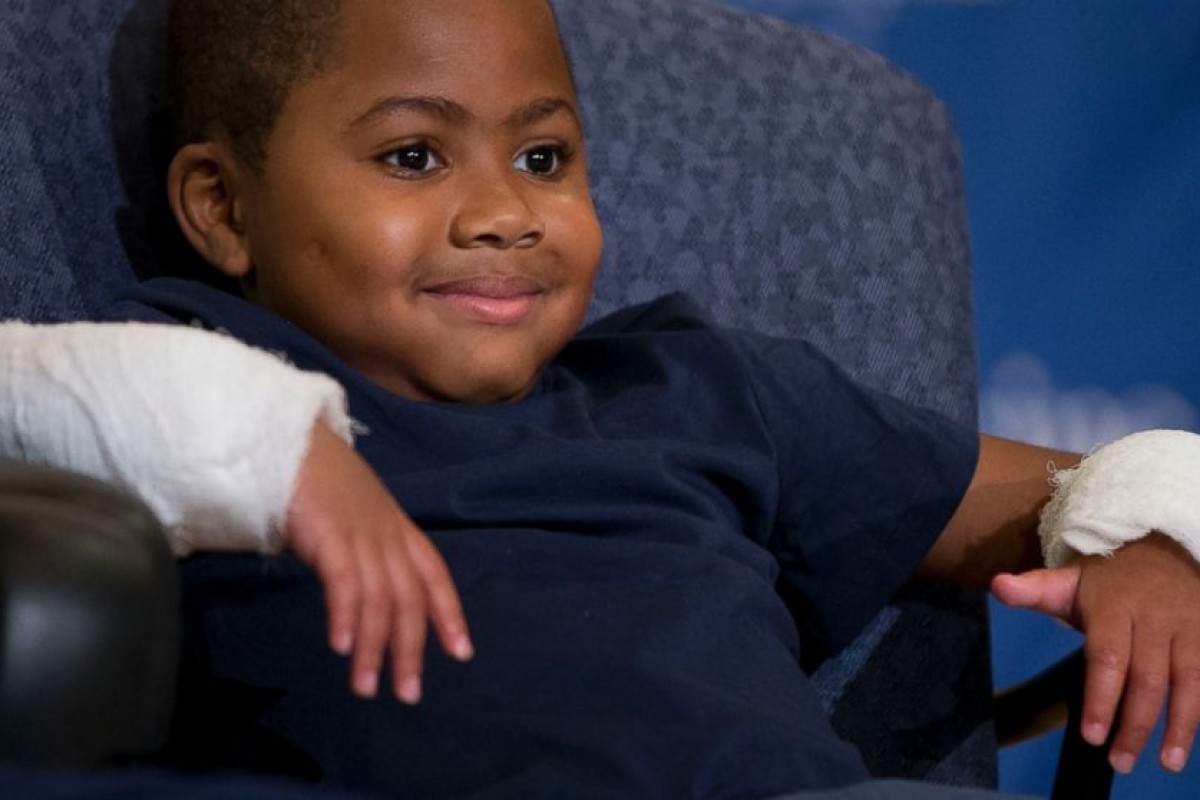Ο Zion είναι το πρώτο παιδί στον κόσμο που υποβλήθηκε σε διπλή μεταμόσχευση χεριών