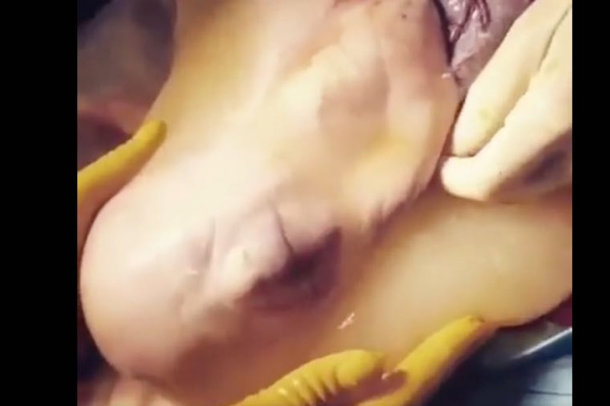 Ακόμα ένα συγκλονιστικό βίντεο μωρού που γεννήθηκε μέσα στον αμνιακό σάκο!