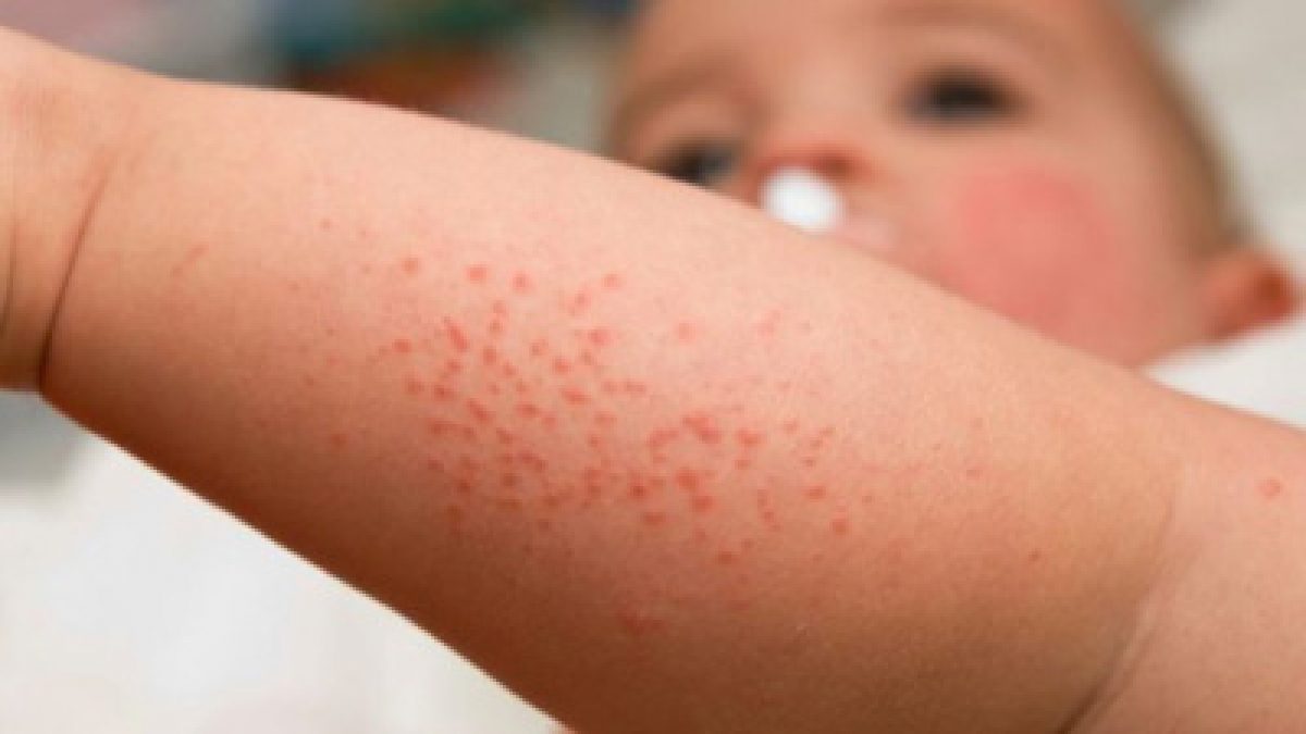 Αλλεργίες νεογνικής- βρεφικής ηλικίας