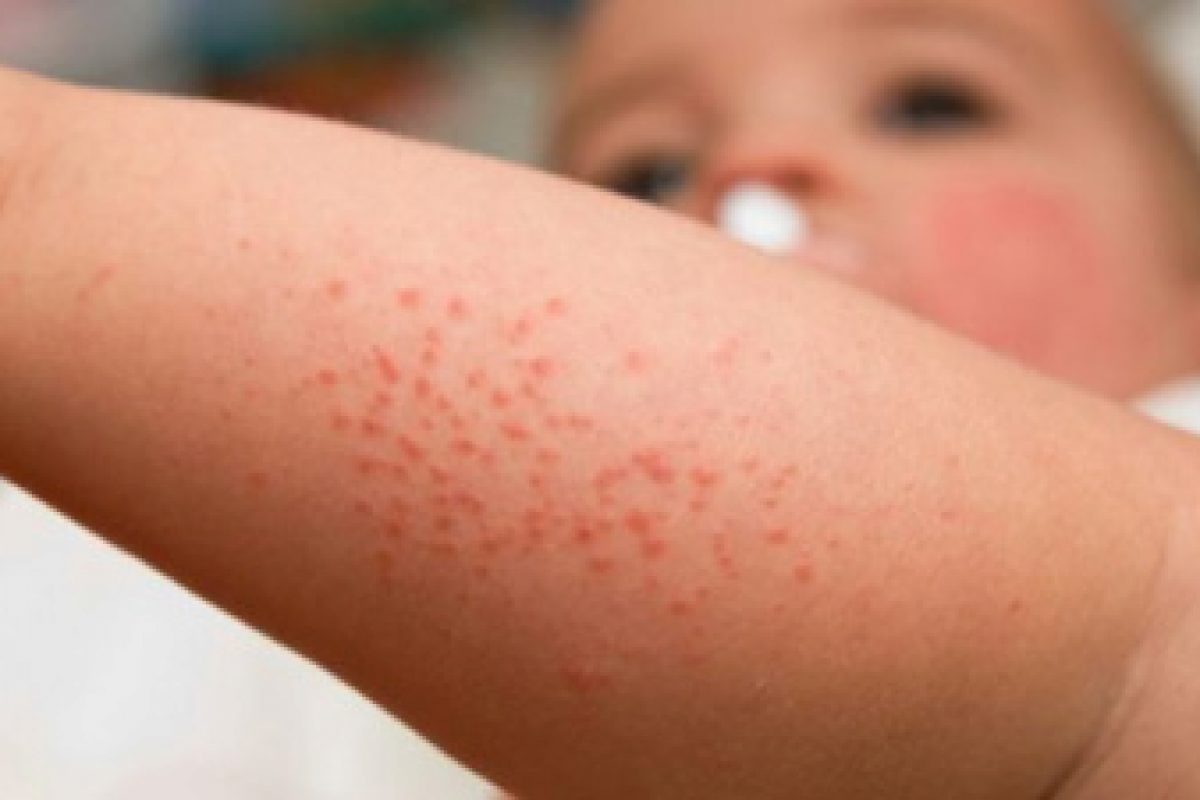 Αλλεργίες νεογνικής- βρεφικής ηλικίας
