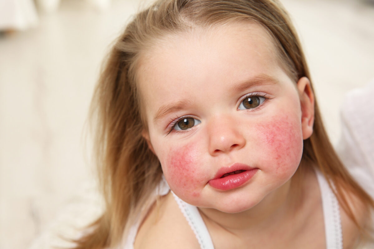 Τροφική αλλεργία στα παιδιά: Τα ύποπτα τρόφιμα και τα πιθανά συμπτώματα